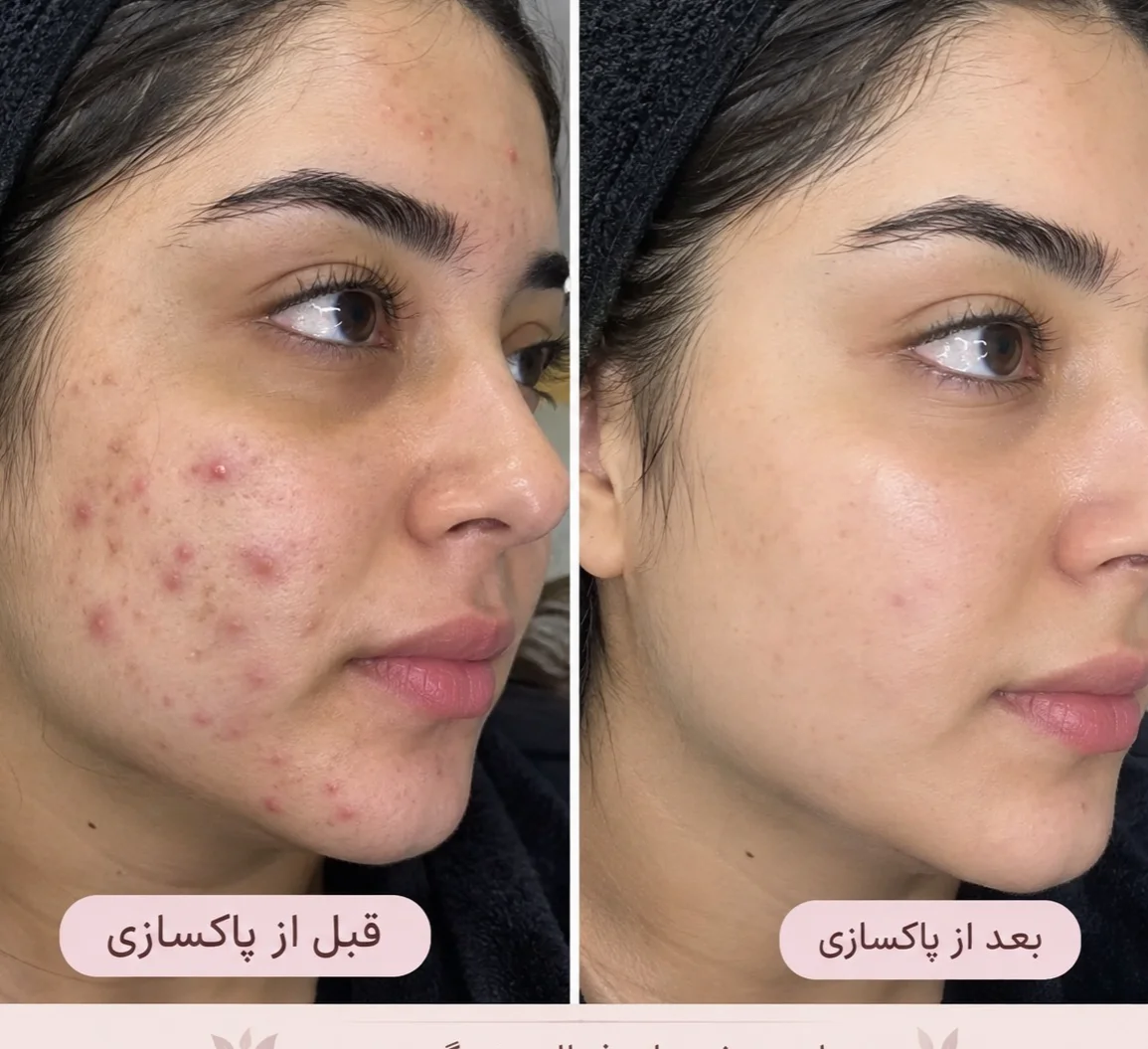 فشیال وپاکسازی تخصصی پوست (سالن زیبایی در یزد) — عکس ۳