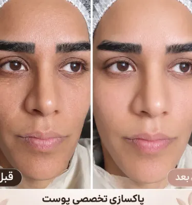 فشیال وپاکسازی تخصصی پوست (سالن زیبایی در یزد)