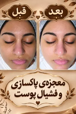 فشیال وپاکسازی تخصصی پوست (سالن زیبایی در یزد)